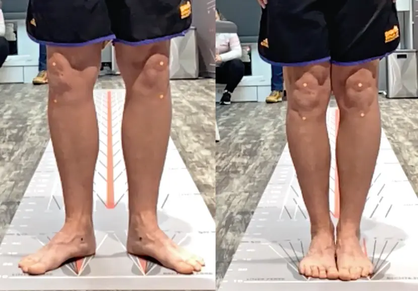 Fallbeispiel Knieschmerz – Statische Aufnahme von Fuß- und Knieachse