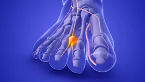 Morton's neuralgia