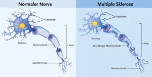 Multiple sclerosis